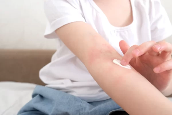 Cuidado de la piel atópica en niños, piel atópica