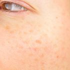 hiperpigmentación, mancas en la piel