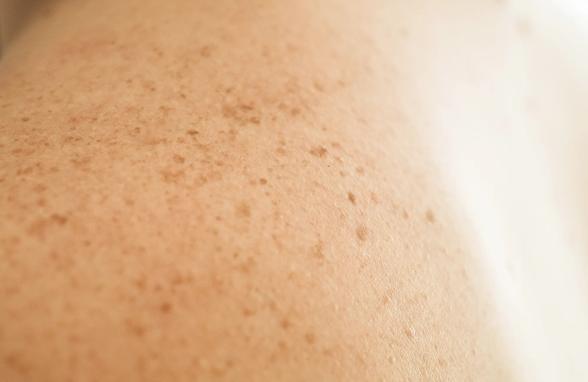 Cáncer de piel: tipos, prevención y autoexploración