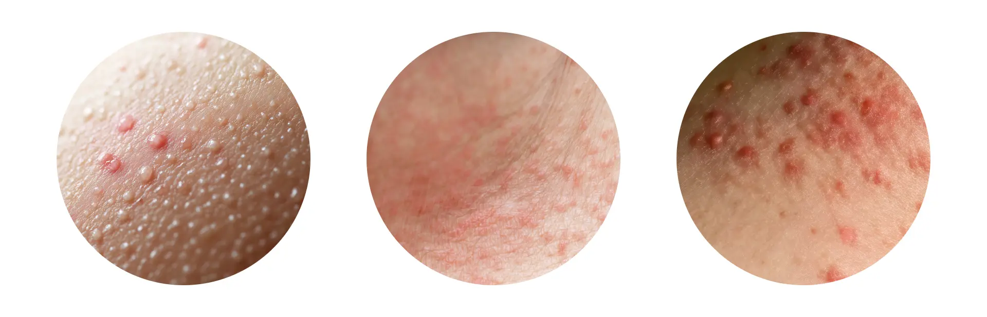 sudamina, miliaria