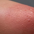 sudamina, miliaria
