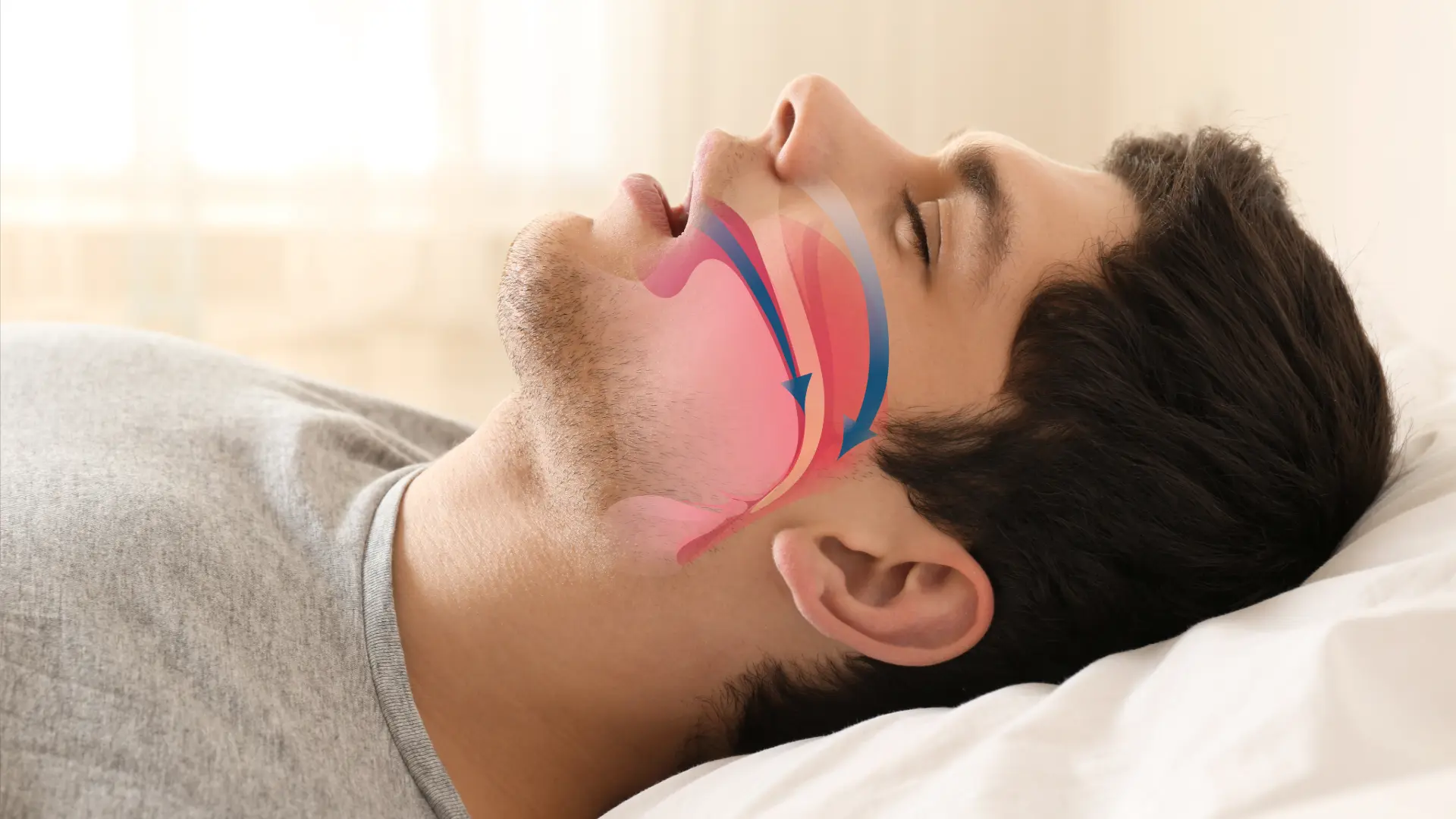 Síndrome de apnea-hipopnea del sueño: causas, síntomas y tratamiento del SAHS