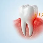 Gingivitis
